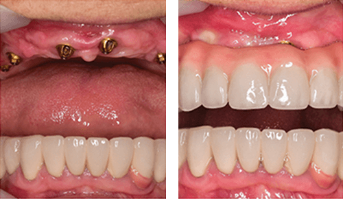 Before After 1