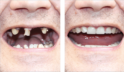 Before After 2