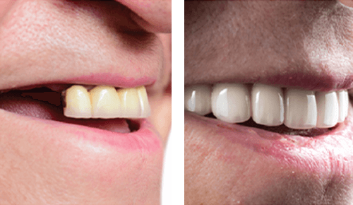 Before After 3