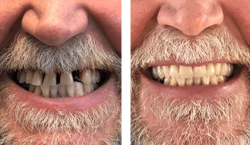 Before After 4